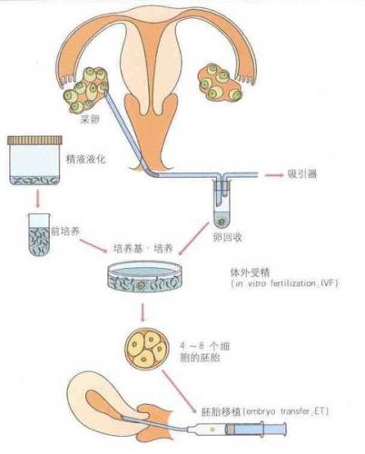 如何提高供卵试管婴儿的受孕率？注意不要剧烈运动